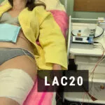 Lipoforeza z ampułkami Kofeina 20%